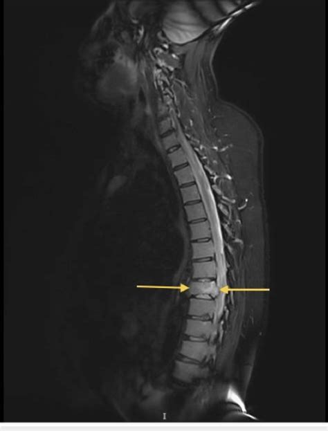 A Spine Mri Without Contrast Revealed A Compression Fracture Of The T8