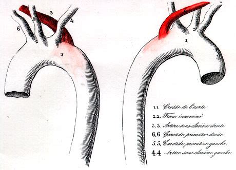 Retroesophageal Right Subclavian Artery