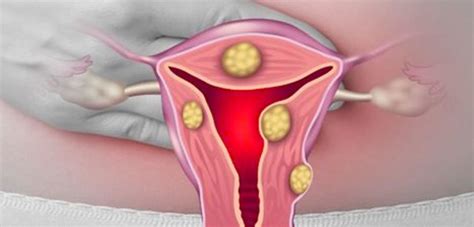 About Uterine Fibroids Fibroid Institute Texas