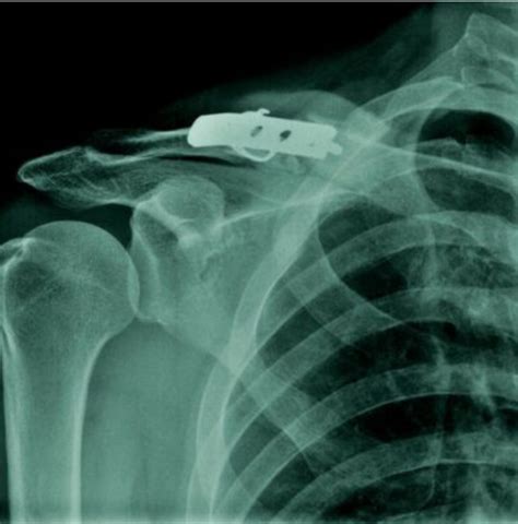 Fractured Collarbone Surgery Surgery For Clavicle Fracture Broken