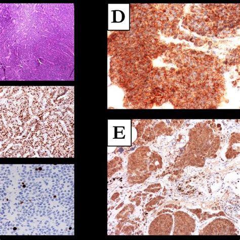 Pulmonary Atypical Carcinoid Primary Tumor A Well Differentiated