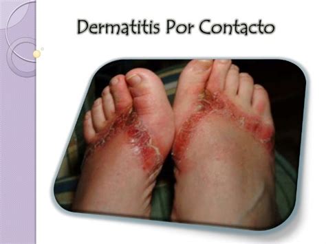 Microbiologia Sjsr Dermatitis Por Contacto