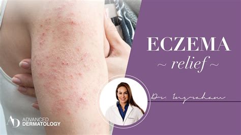 Treatments For Eczema Youtube