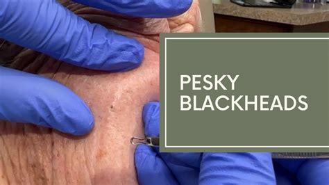 Pesky Blackheads Dr Derm Youtube