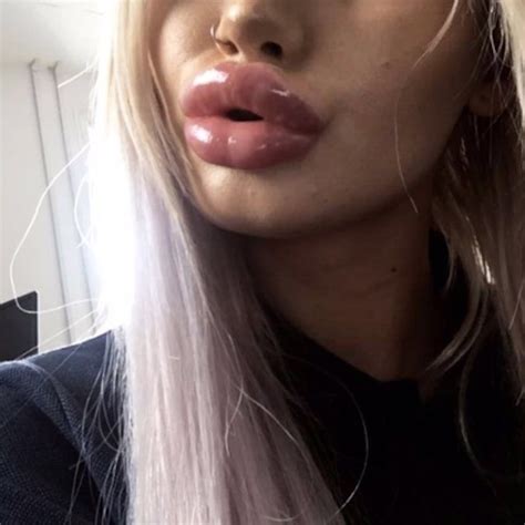 Pin By Anders Rudbeck On Lips And Fillers Fake Lips Lip Fillers Barbie Girl