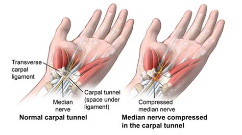 Natural Remedies For Carpal Tunnel Syndrome Healthfirst Spine And Wellness