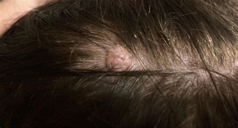 Growing Lump On Head Any Ideas What It Might Be I Have One Smaller