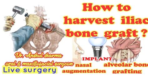 Harvesting Autogenous Cancellous Bone Graft From Anterior Ilaic Crest