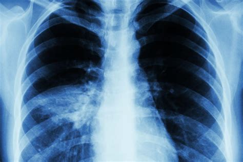 Discovery May Help Patients Beat Deadly Pneumonia Uva Today
