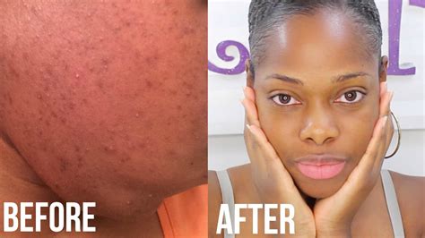 How To Get Rid Of Hyperpigmentation Irritated Acne Prone Skin And Demo