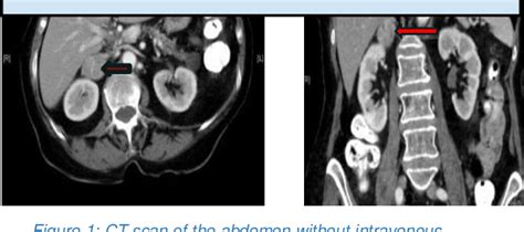 Figure 1 From Malignant Hypertension Leading To A Diagnosis Of An