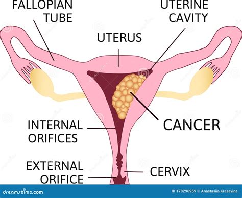 Uterine Cancer Vector Poster Or Chart With Cancerous Tumor Cells On Endometrium Tissue Of Uterus