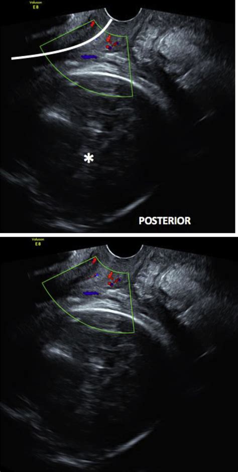 Transvaginal Ultrasound Image 1 The White Curve An Elongated Cervix