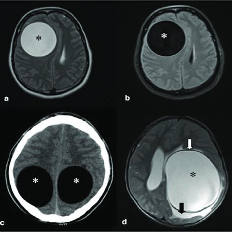 Axial Brain Ct Scans Shows A Multiple Hydatid Cysts Asterisks In A