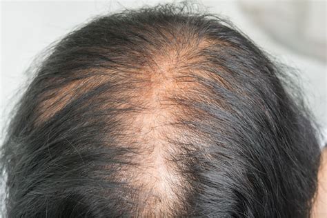 Hair Loss Treatment Pattern Hair Loss Treatment The Lifestyle Clinic