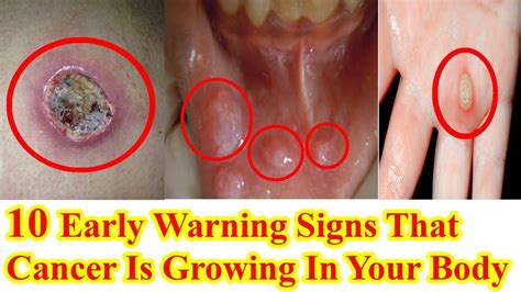 Early Warning Signs That Cancer Is Growing In Your Body Youtube