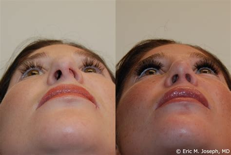 Eric M Joseph Md Rhinoplasty Before And After Deviated Septum Repair And Straightened Nasal