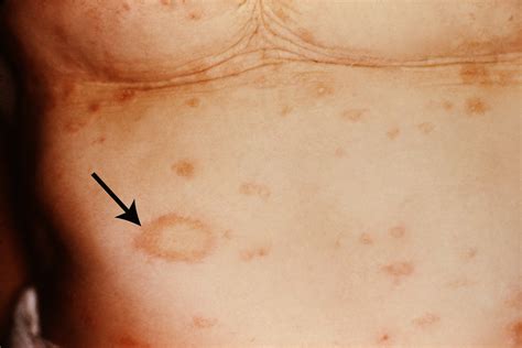 Pityriasis Rosea Symptome Diagnose Und Behandlung Med