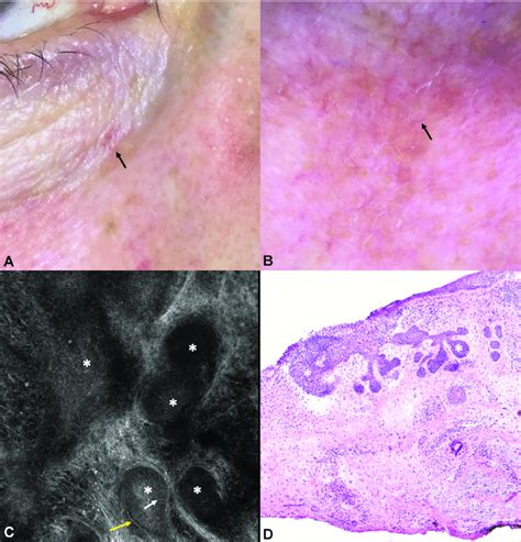 Nodular Basal Cell Carcinoma On A H Site Area With Histopathologic