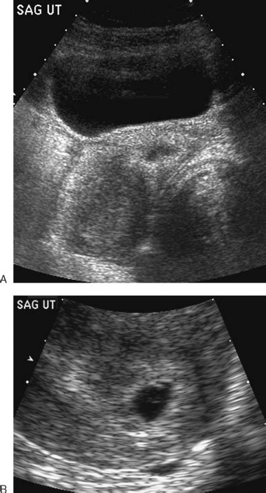 Transvag Ultrasound During Pregnancy Transvaginal Ultrasonography And