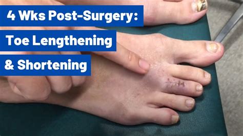 Cosmetic Foot Surgery Toronto Kicosmetic