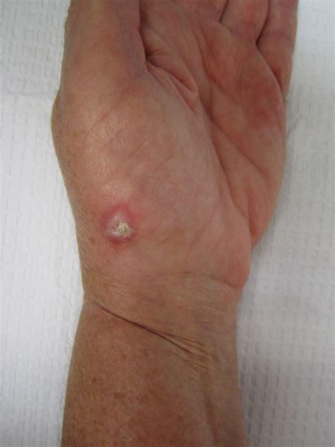 Lumps And Bumps And Cysts Of The Hand 2022