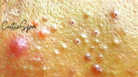 Clearing Clogged Pores Due To Sebaceous Hyperplasia Blackheads And