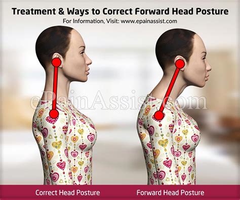 Forward Head Posturecausessymptomstreatmentexercises 2023
