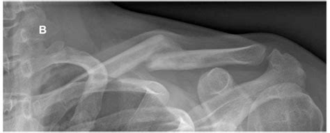 Nonoperative Treatment Of Midshaft Clavicle Fractures In Adults