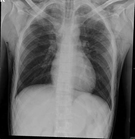 Bilateral Surgical Emphysema At Subcutaneous Tissues Of The Chest And