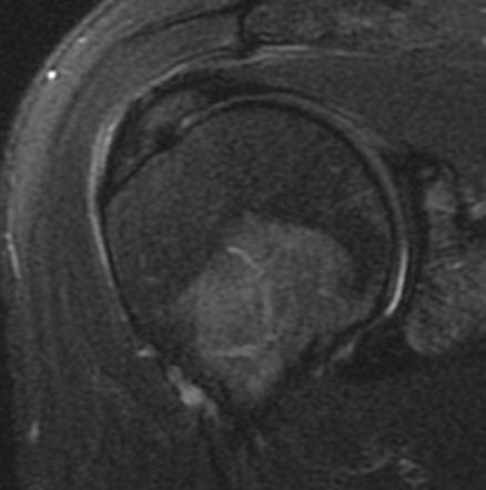Supraspinatus Tendinosis Radiology Case Radiopaedia Org Hot Sex Picture