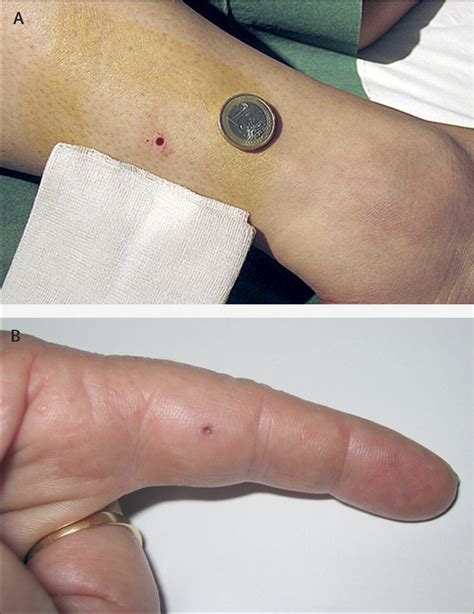 Skin Biopsy In The Management Of Peripheral Neuropathy The Lancet