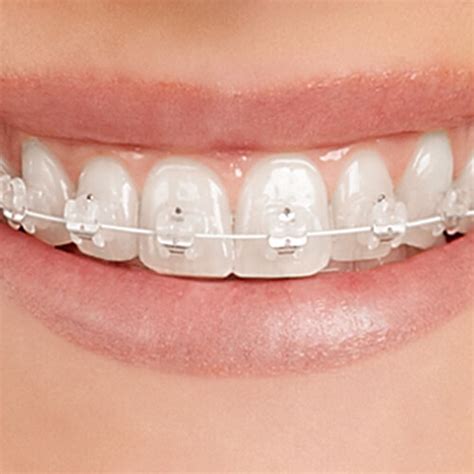 Teeth Empower Clear Gig Harbor Tacoma Orthodontics