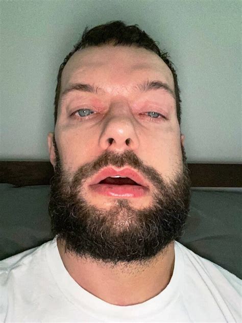 Finn Bálor Shares Post Surgery Photo