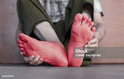 Tingling And Burning Sensation In Foot Of Asian Man Foot Pain Sensory