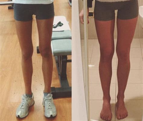 Anorexic Whose Weight Plummeted To Seven Stone Reveals How Instagram Photo Saved Her Daily