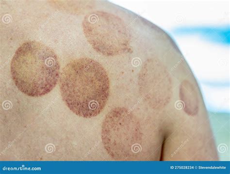 Circular Bruises On A Back And Shoulder After Cupping Therapy Stock