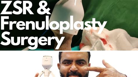 Frenuloplasty And Zsr Circumcision For Phimosisfrenulum Breve By Dr