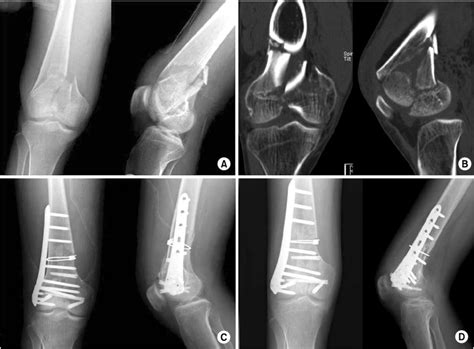 A Initial Radiographs Show The Distal Femoral Fracture Of Ao Type C3