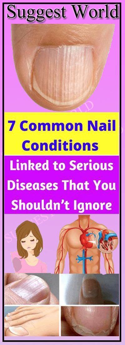7 Common Nail Conditions Linked To Serious Diseases That You Shouldnt