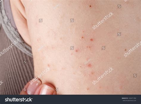 Allergic Rash Dermatitis Back Skin Of Patient Stock Photo 103471784