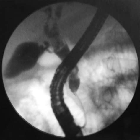 Endoscopic Retrograde Cholangiogram Showing Irregular Filling Defect