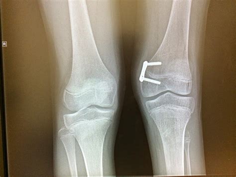 Fibular Hemimelia Leg Lengthening 8 Plate 3 12 Months Post Surgery