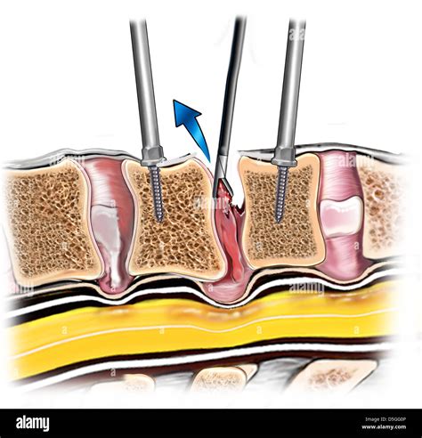 Spine Bone Fusion With Fibular Allograft Caspar Pin Distractor Stock