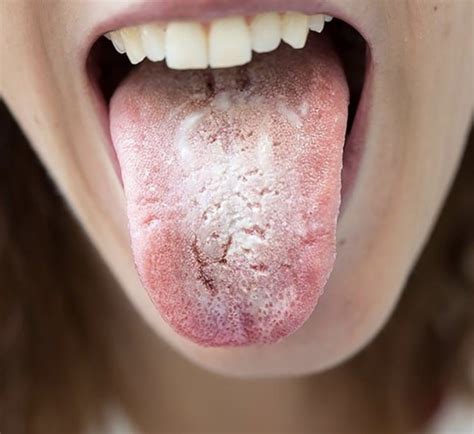 Ayurvedic Tongue Reading For Personalized Healing Sally Goldfinger