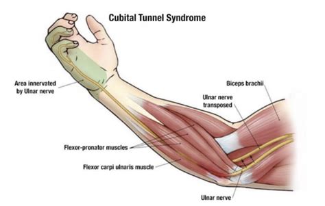Cubital Tunnel Syndrome Teton Hand Surgery