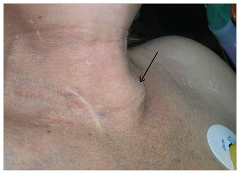 Neck swelling secondary to severe hyperplasia of autotransplanted