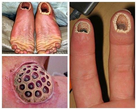 What Is Trypophobia Skin Images And Photos Finder