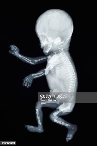 Baby X Ray Photos And Premium High Res Pictures Getty Images