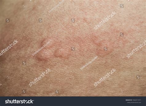 Urticaria On Skin Rashes Which Urticaria ภาพสต็อก 1566311971 Shutterstock